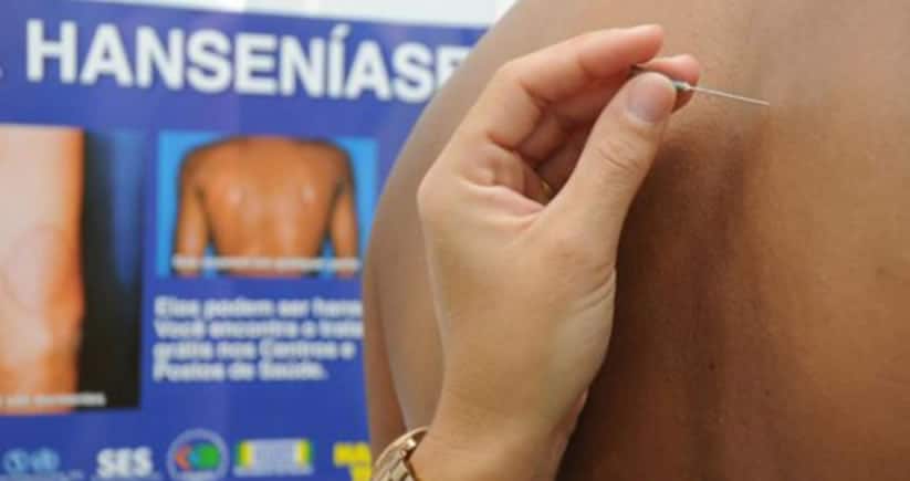 Tipos de hanseníase: saiba como cuidar e prevenir