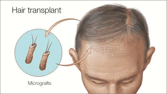 Como funciona o transplante capilar
