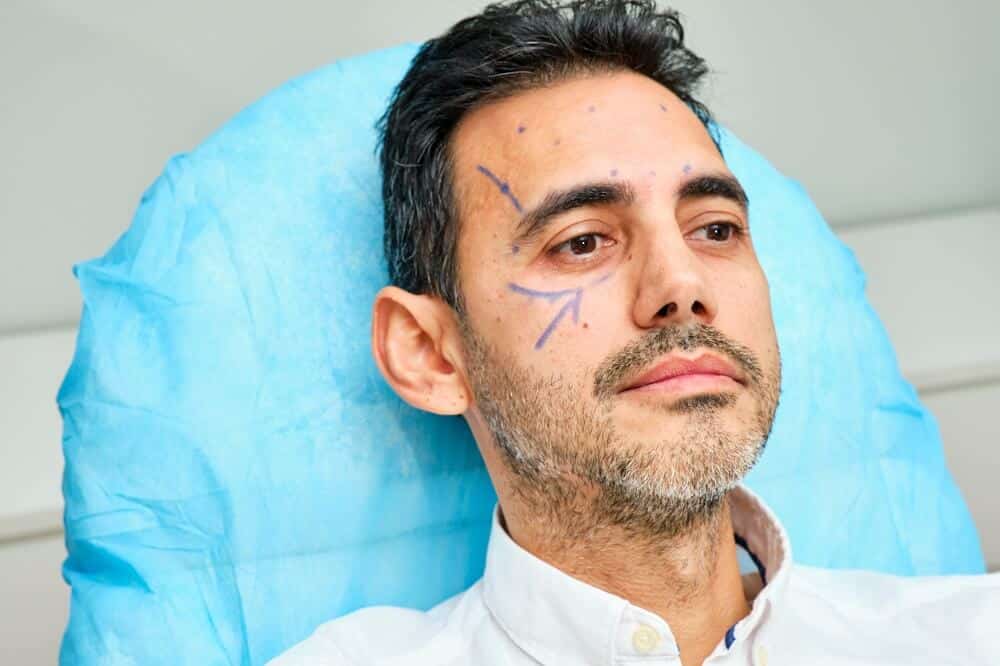 Homem em clínica art corporis com o rosto com traços para tratamento de lifting facial