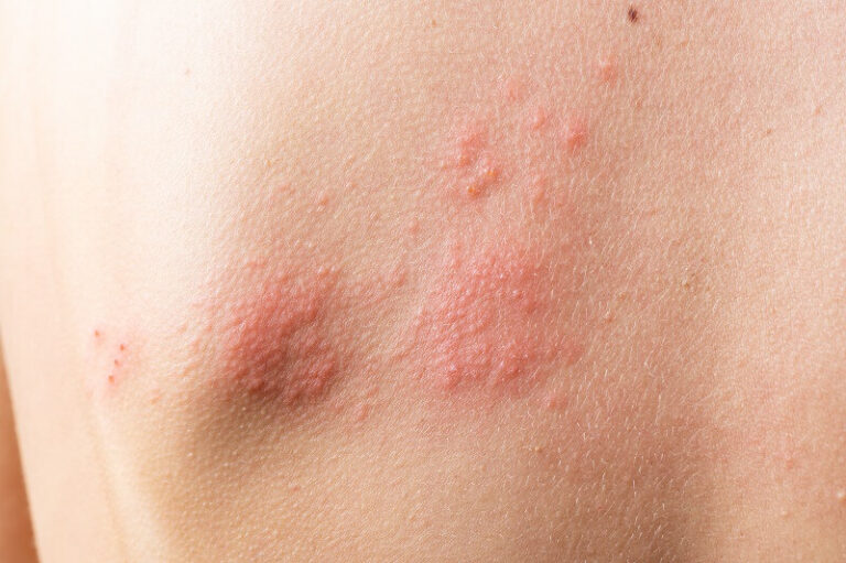 Dermatite Atópica: Causas, Sintomas e Tratamentos Eficazes