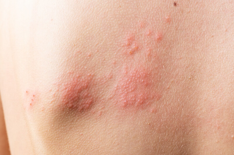 Dermatite Atópica: Causas, Sintomas e Tratamentos Eficazes