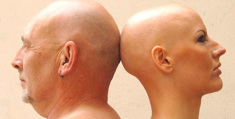 Alopecia Areata