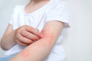 tratamento de eczema