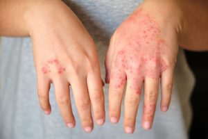 Alívio para Dermatite
