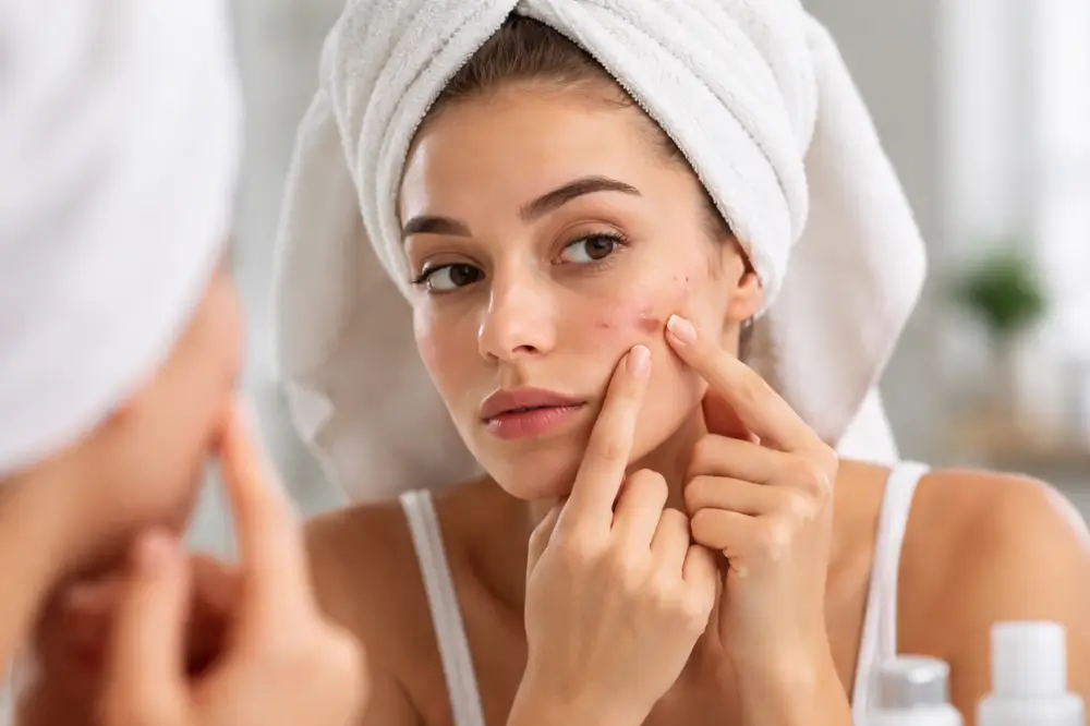 Acne causas tratamentos e como acabar de vez com as espinhas