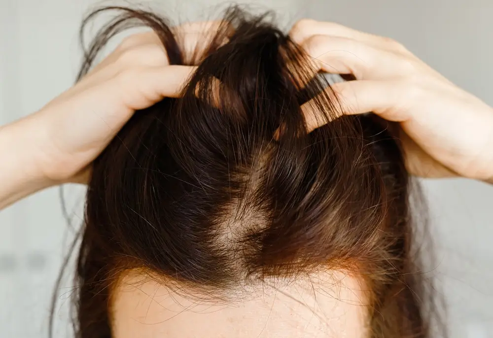 Transplante capilar em mulheres como funciona e resultados esperados