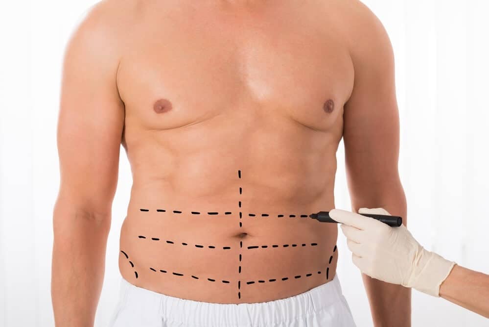 abdominoplastia masculina preco