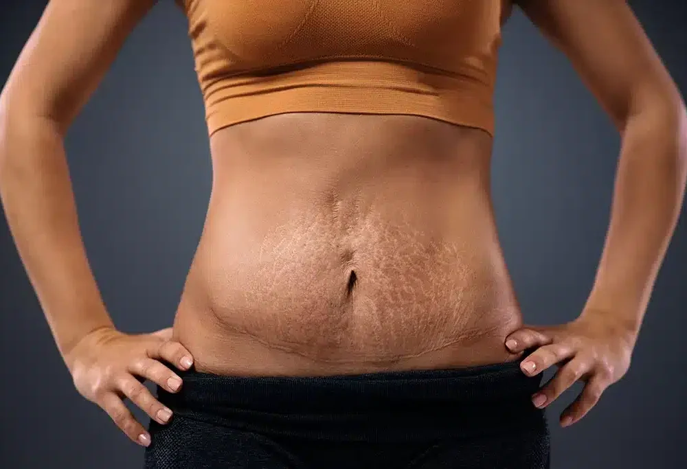 Abdominoplastia