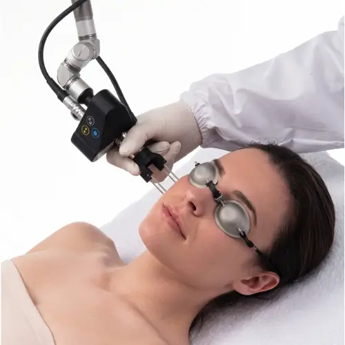 Aplicação de laser de CO₂ SmartXide Punto no rosto de paciente com óculos de proteção.