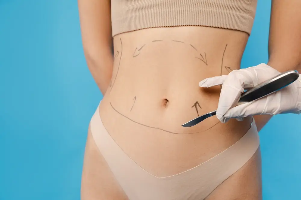 Lipoescultura como manter os resultados após a cirurgia