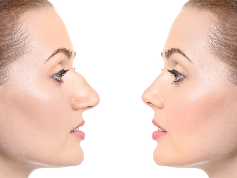 Rinoplastia