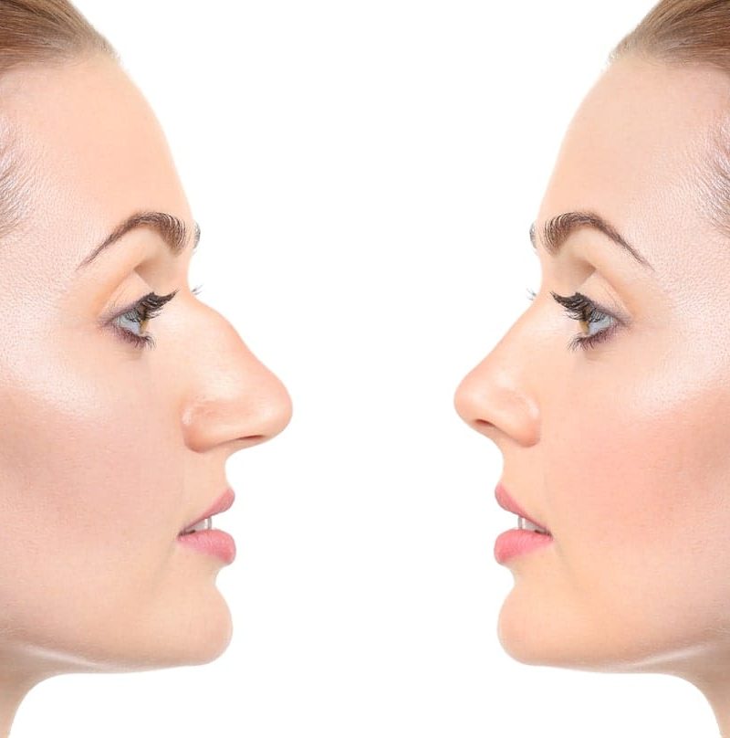 Rinoplastia