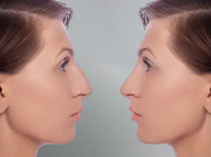 Rinoplastia cirurgia do nariz