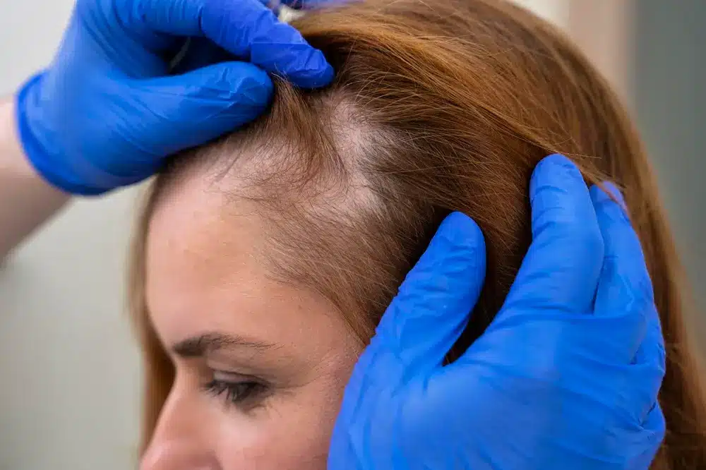 Transplante capilar em mulheres