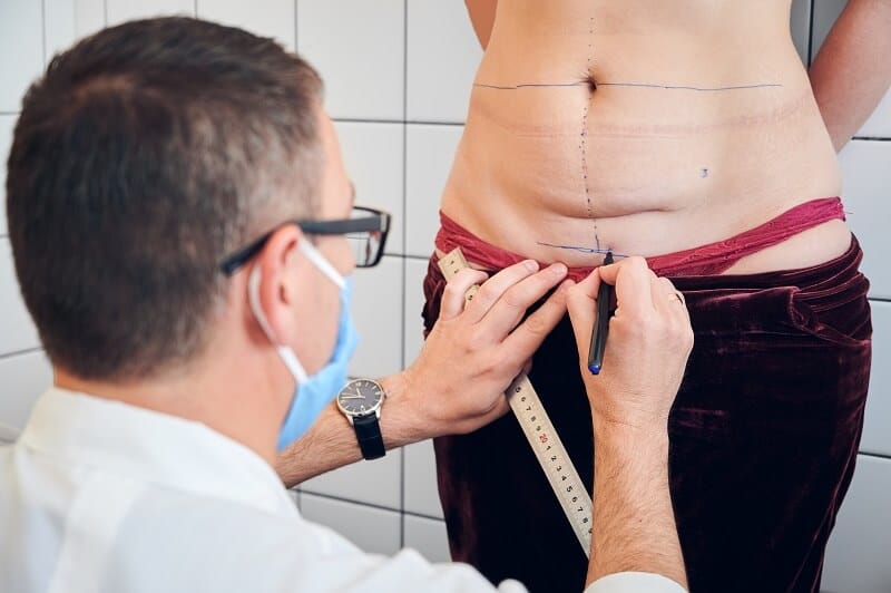 A lipoaspiração é um procedimento estético que consiste na remoção de gordura localizada, através de uma incisão na pele.