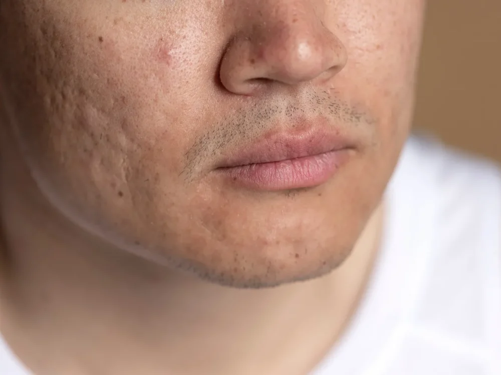 Avaliação dermatológica de acne.