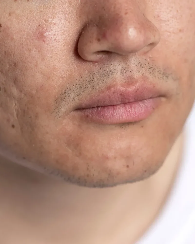 Avaliação dermatológica de acne.