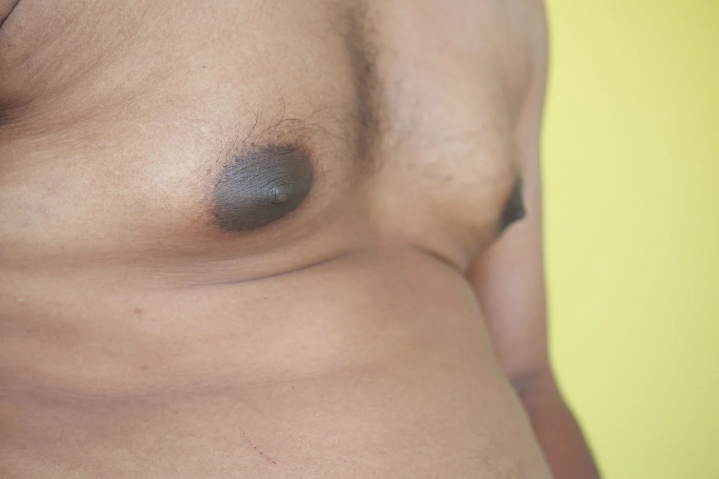 Detalhe do aumento da mama masculina, com aréola mais larga.