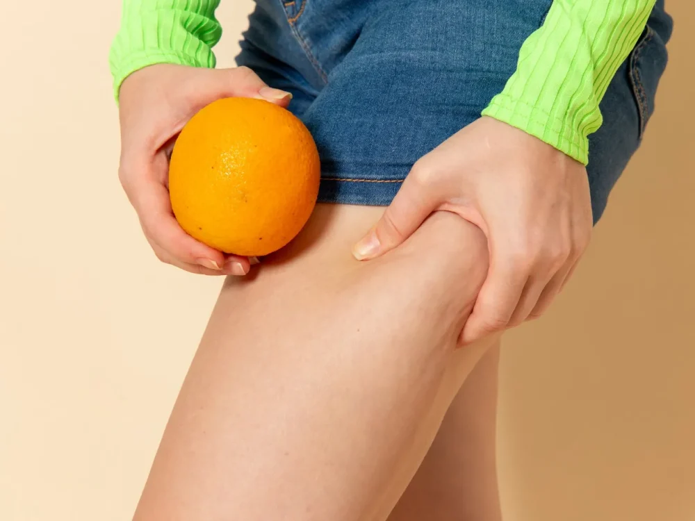 Avaliação dermatológica de celulite.