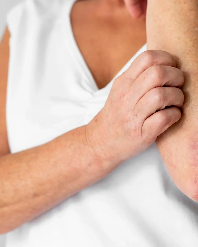Avaliação dermatológica de lesão inflamatória da pele.