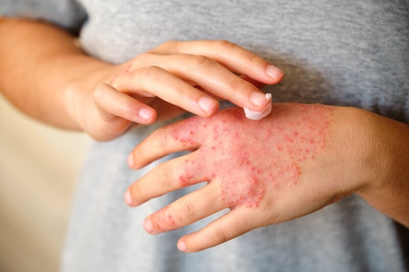 dermatologista eczema