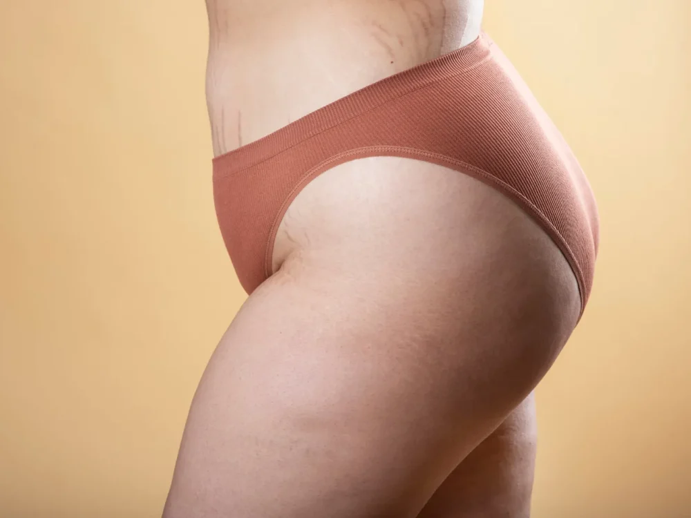 Avaliação dermatológica de estrias.