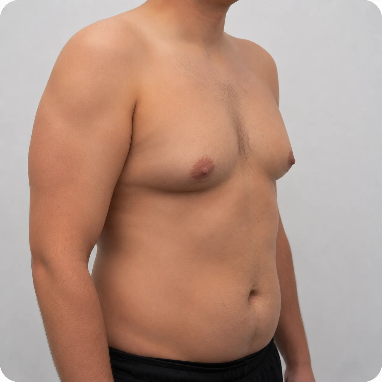 Homem com ginecomastia, em foto clínica de avaliação, com fundo neutro.