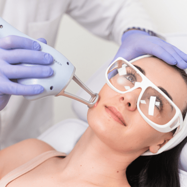 Aplicação de laser facial com óculos de proteção.
