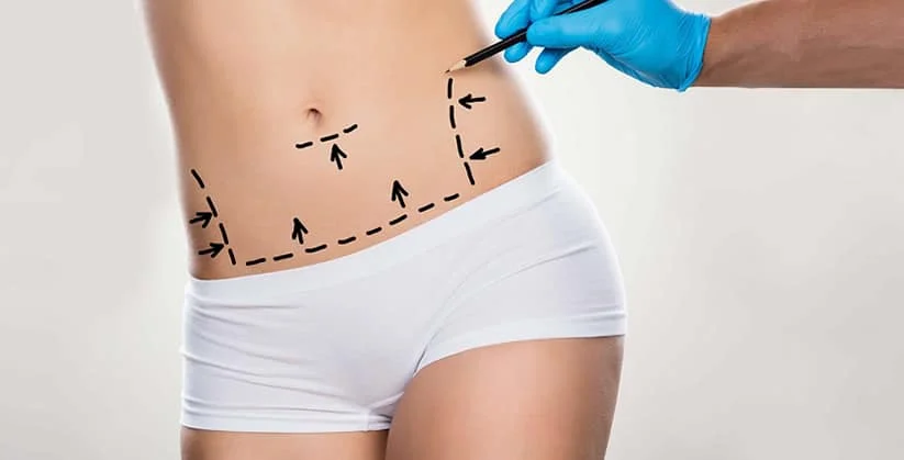 Lipoaspiração