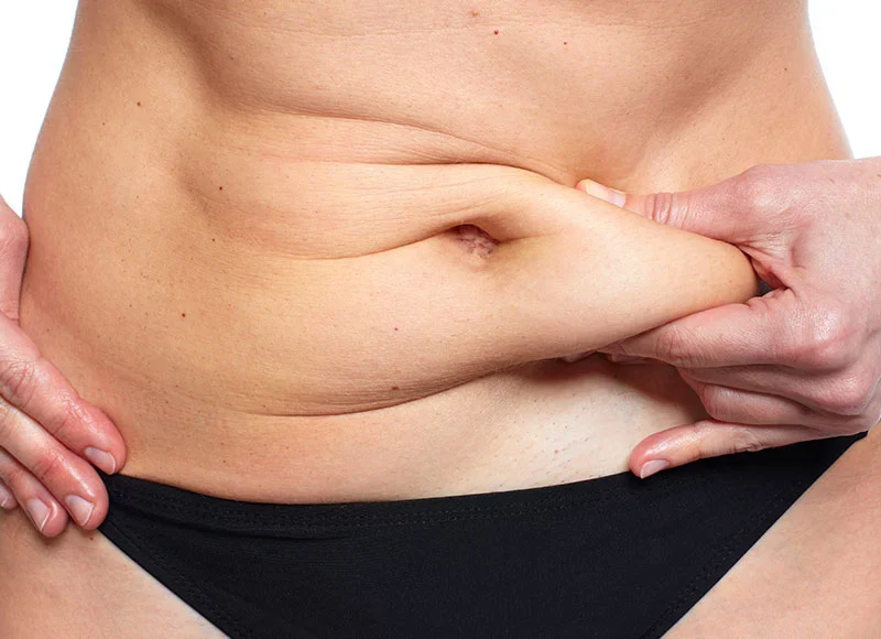 Lipoescultura: saiba mais sobre os benefícios dessa técnica para reduzir a gordura localizada!