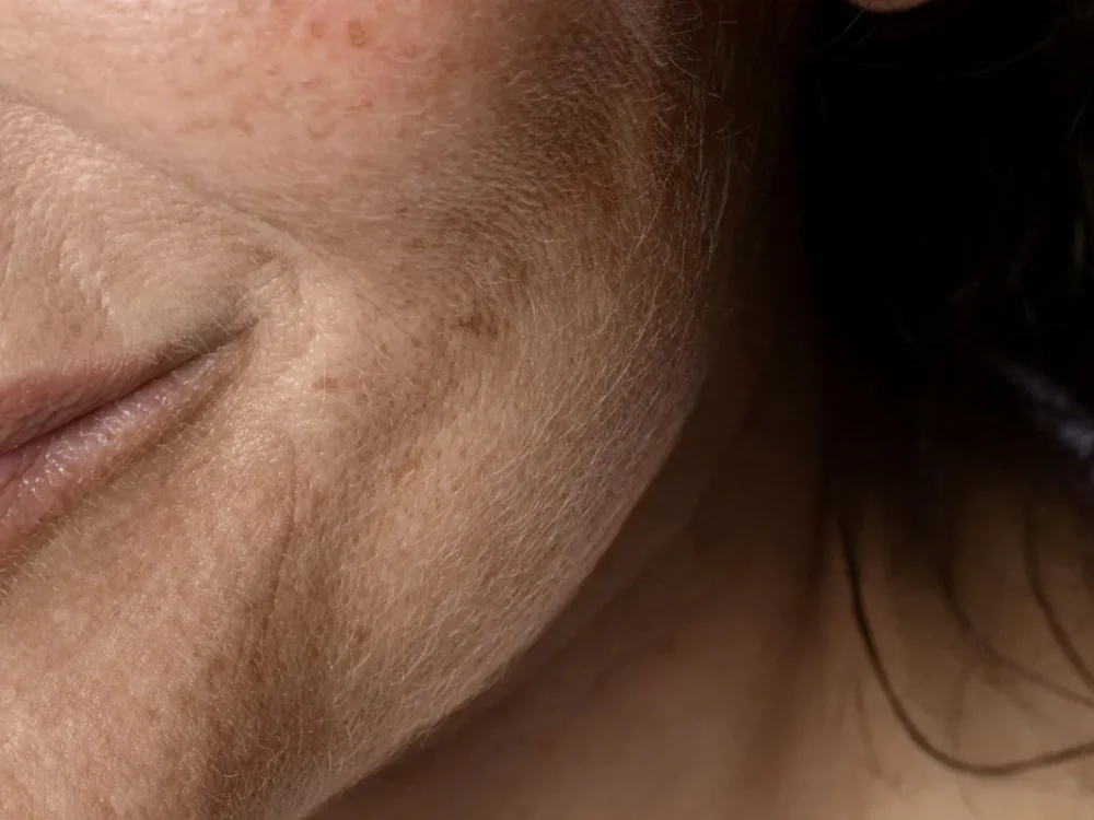 Avaliação dermatológica de manchas na pele.