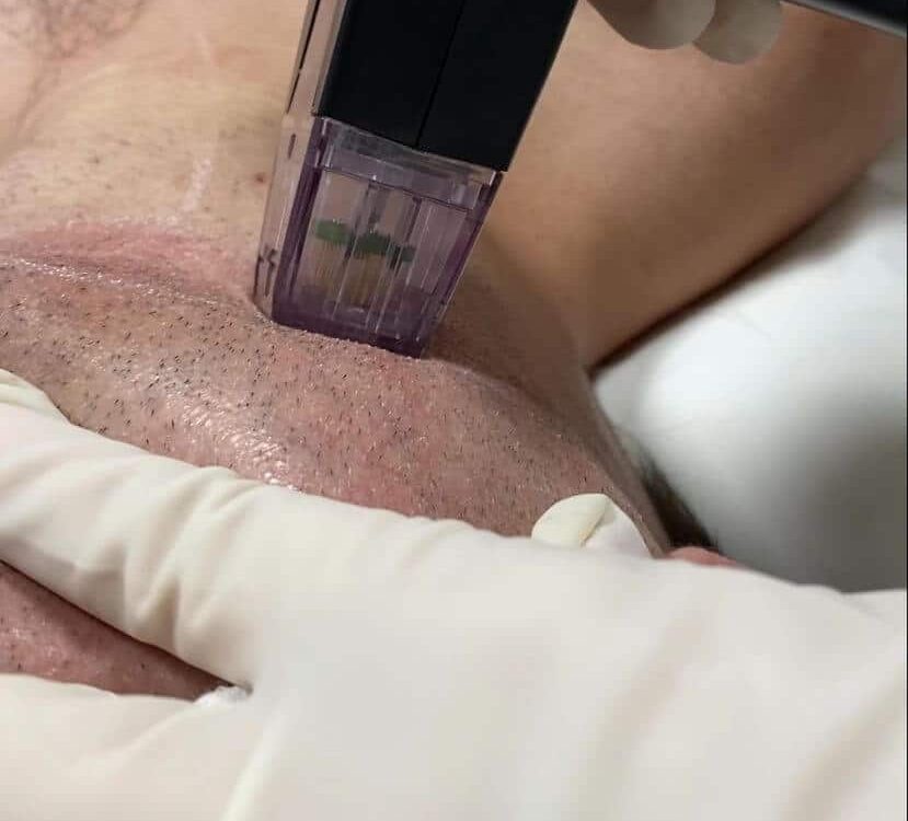 Cabeçote do Morpheus 8 aplicando radiofrequência microagulhada na pele.