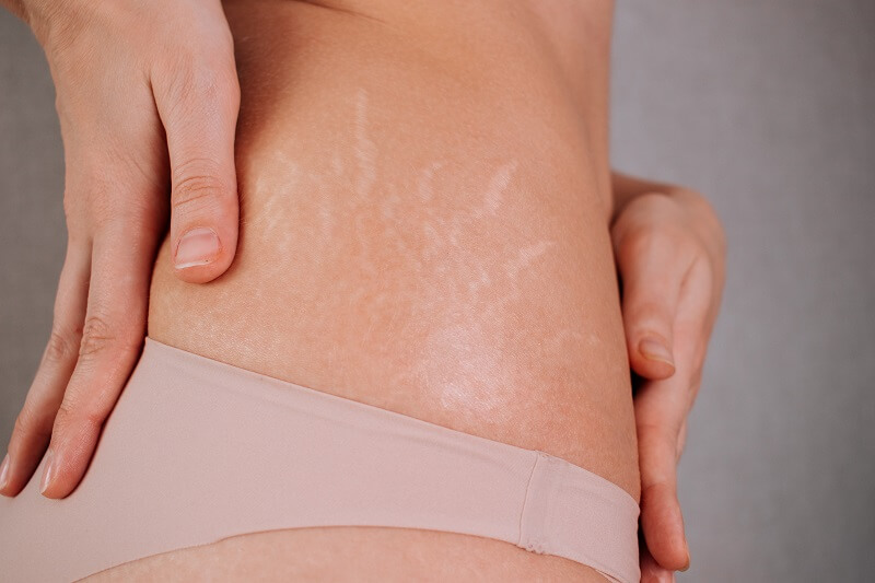 Prevenir e Tratar Estrias de Forma Eficiente