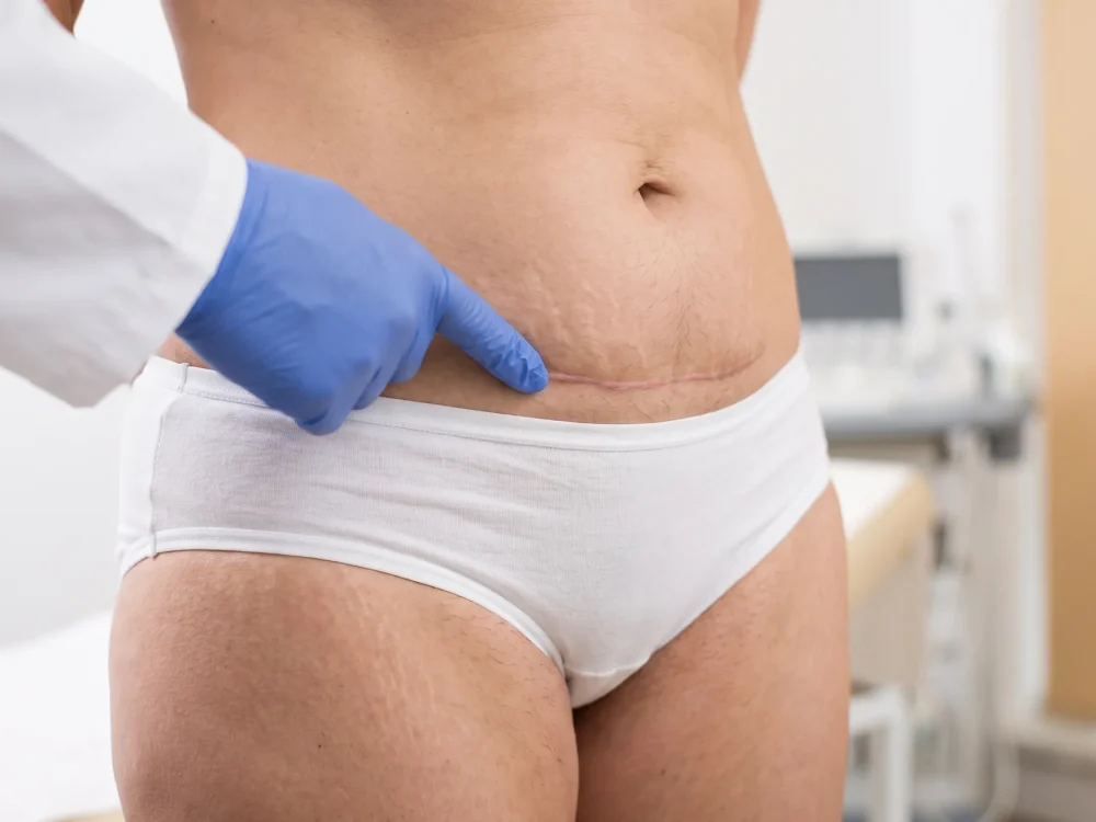 Cicatriz de cesárea avaliada antes da abdominoplastia.