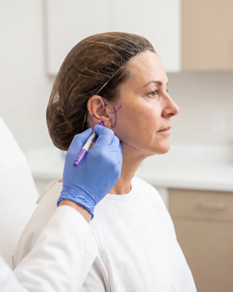 Marcação facial com caneta cirúrgica, em planejamento de lifting.